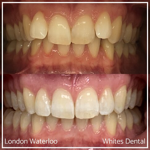 Successful Invisalign Worst Cases Before and After Results in London Waterloo and Marble Arch - Case Study 15