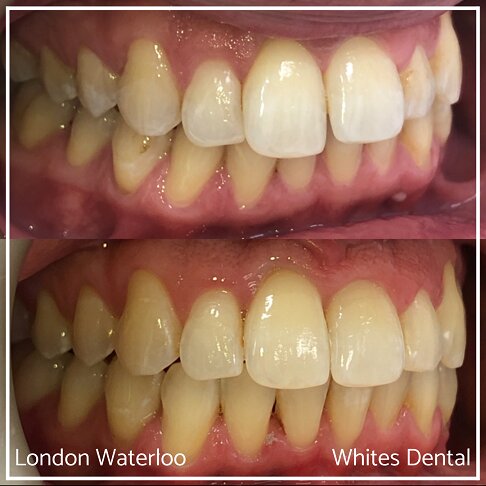 Successful Invisalign Overcrowding Before and After Results in London Waterloo and Marble Arch - Case Study 16