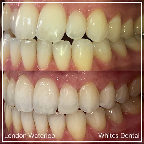 Successful Invisalign Overcrowding Before and After Results in London Waterloo and Marble Arch - Case Study 17