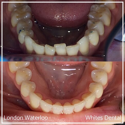 Successful Invisalign Overcrowding Before and After Results in London Waterloo and Marble Arch - Case Study 18