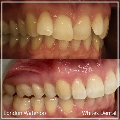 Successful Invisalign Overcrowding Before and After Results in London Waterloo and Marble Arch - Case Study 19