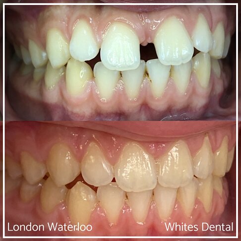 Successful Invisalign Teeth Gap Before and After Results in London Waterloo and Marble Arch - Case Study 2