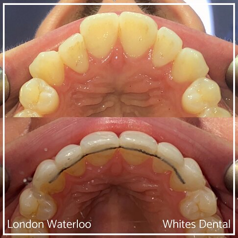 Successful Invisalign Overbite and Underbite Before and After Results in London Waterloo and Marble Arch - Case Study 2