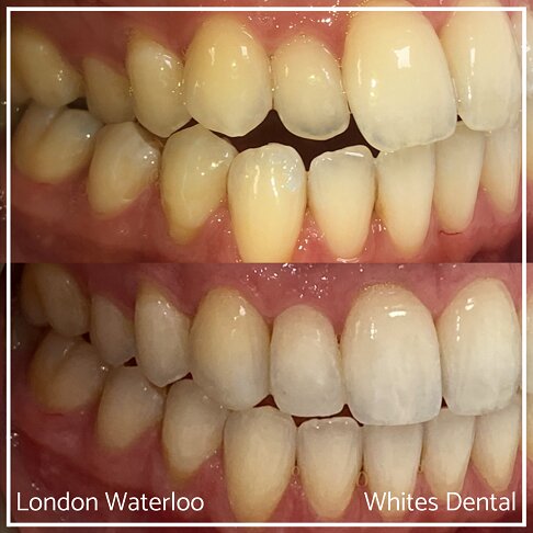 Successful Invisalign Overcrowding Before and After Results in London Waterloo and Marble Arch - Case Study 20