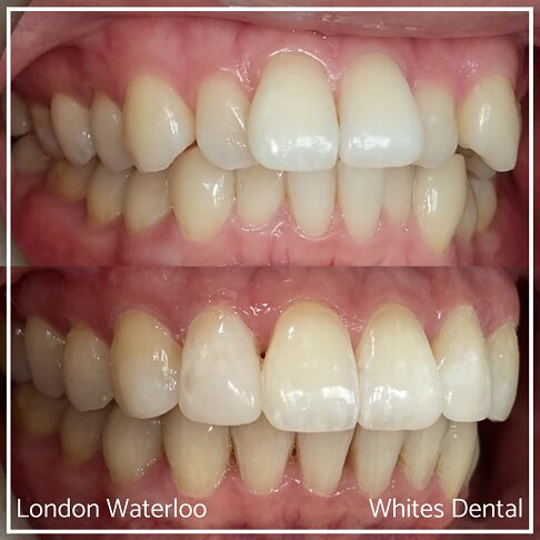 Successful Invisalign Overcrowding Before and After Results in London Waterloo and Marble Arch - Case Study 21