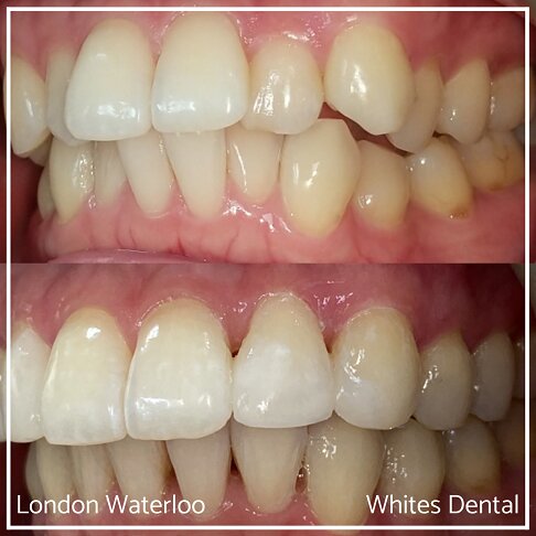 Successful Invisalign Overcrowding Before and After Results in London Waterloo and Marble Arch - Case Study 26