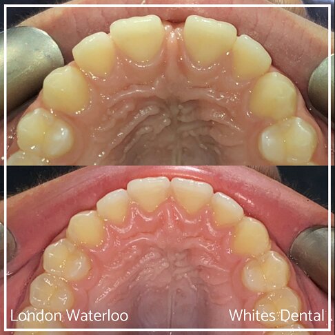 Successful Invisalign Teeth Gap Before and After Results in London Waterloo and Marble Arch - Case Study 3