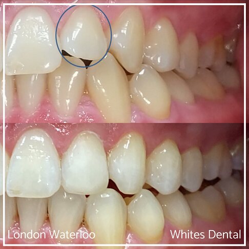 Successful Invisalign Overcrowding Before and After Results in London Waterloo and Marble Arch - Case Study 3