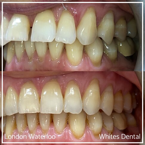 Successful Invisalign Teeth Gap Before and After Results in London Waterloo and Marble Arch - Case Study 4