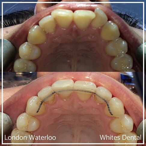 Successful Invisalign Overbite and Underbite Before and After Results in London Waterloo and Marble Arch - Case Study 4