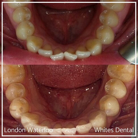 Successful Invisalign Overcrowding Before and After Results in London Waterloo and Marble Arch - Case Study 4