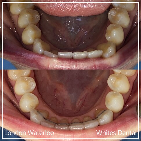 Successful Invisalign Worst Cases Before and After Results in London Waterloo and Marble Arch - Case Study 4