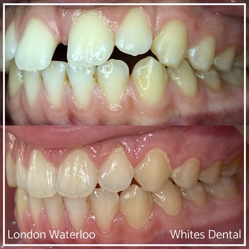 Successful Invisalign Teeth Gap Before and After Results in London Waterloo and Marble Arch - Case Study 5