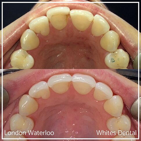 Successful Invisalign Overbite and Underbite Before and After Results in London Waterloo and Marble Arch - Case Study 5