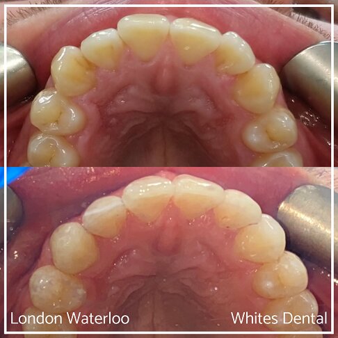 Successful Invisalign Overcrowding Before and After Results in London Waterloo and Marble Arch - Case Study 5