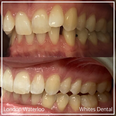 Successful Invisalign Worst Cases Before and After Results in London Waterloo and Marble Arch - Case Study 5