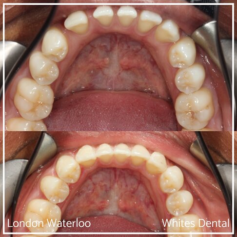 Successful Invisalign Teeth Gap Before and After Results in London Waterloo and Marble Arch - Case Study 6