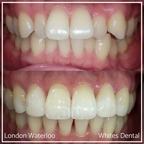 Successful Invisalign Worst Cases Before and After Results in London Waterloo and Marble Arch - Case Study 6