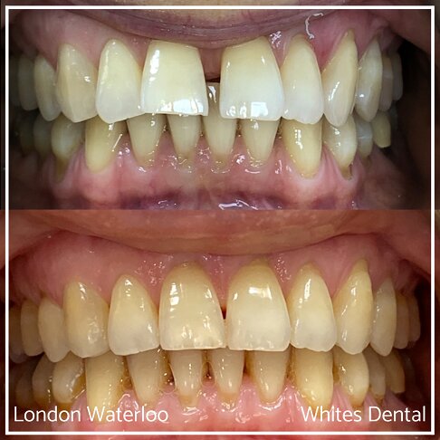 Successful Invisalign Teeth Gap Before and After Results in London Waterloo and Marble Arch - Case Study 7