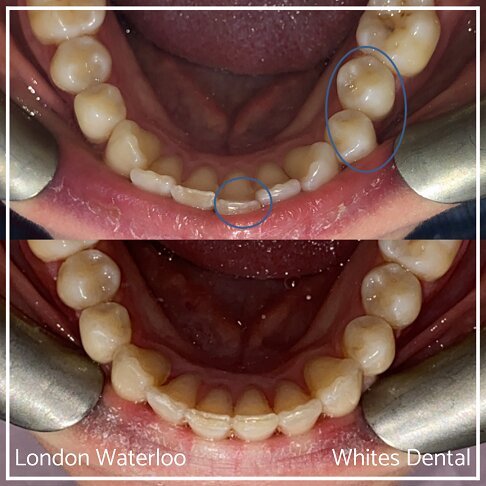 Successful Invisalign Overcrowding Before and After Results in London Waterloo and Marble Arch - Case Study 7