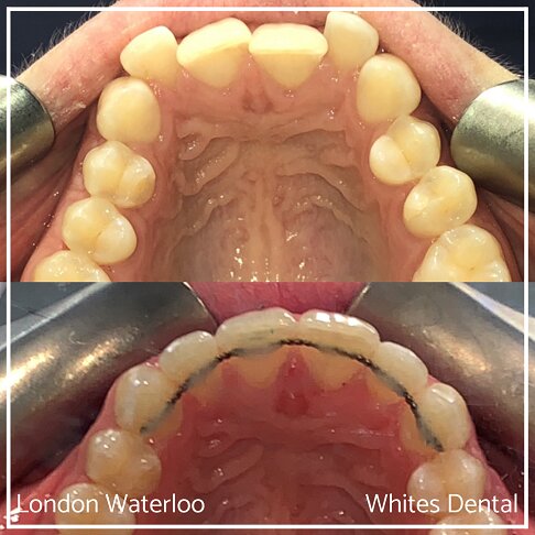 Successful Invisalign Worst Cases Before and After Results in London Waterloo and Marble Arch - Case Study 7