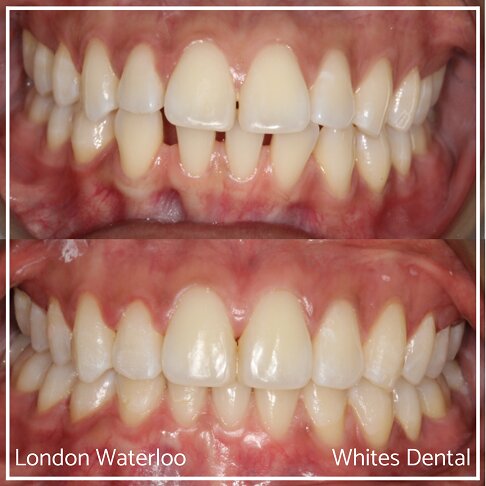 Successful Invisalign Teeth Gap Before and After Results in London Waterloo and Marble Arch - Case Study 8