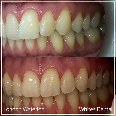 Successful Invisalign Overcrowding Before and After Results in London Waterloo and Marble Arch - Case Study 8