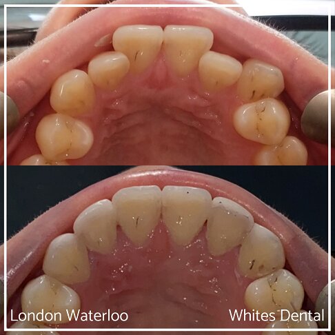 Successful Invisalign Worst Cases Before and After Results in London Waterloo and Marble Arch - Case Study 8