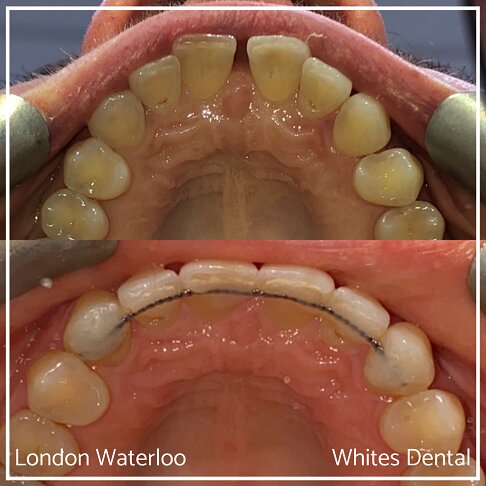 Successful Invisalign Teeth Gap Before and After Results in London Waterloo and Marble Arch - Case Study 9