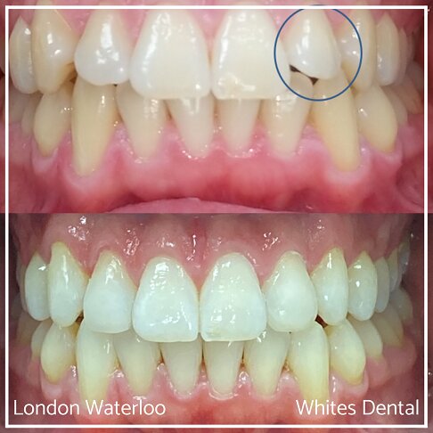 Successful Invisalign Overcrowding Before and After Results in London Waterloo and Marble Arch - Case Study 9