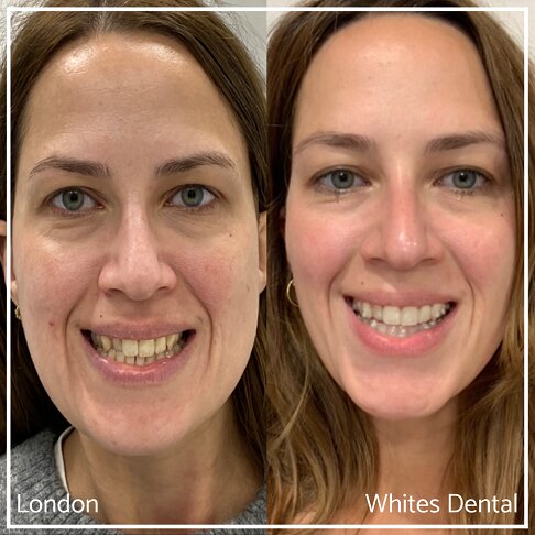 Successful Invisalign Transformation Before and After in London Waterloo and Marble Arch - Case Study 2