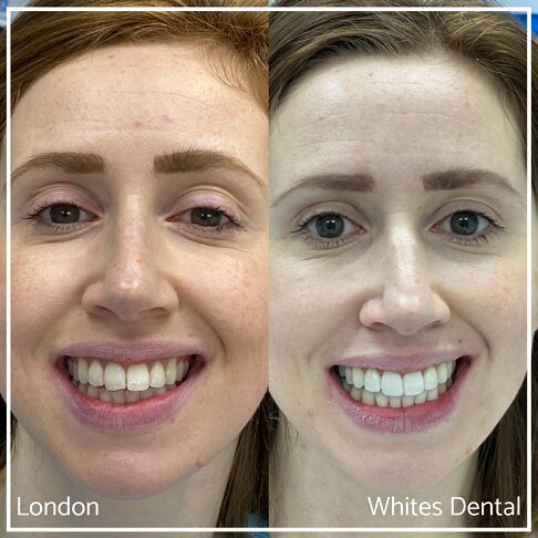 Successful Invisalign Transformation Before and After in London Waterloo and Marble Arch - Case Study 3