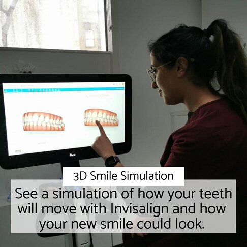 invisalign final results | Whites Dental