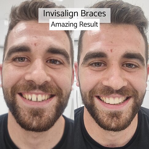 Invisalign | Whites Dental