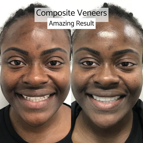 Composite Veneers London 9