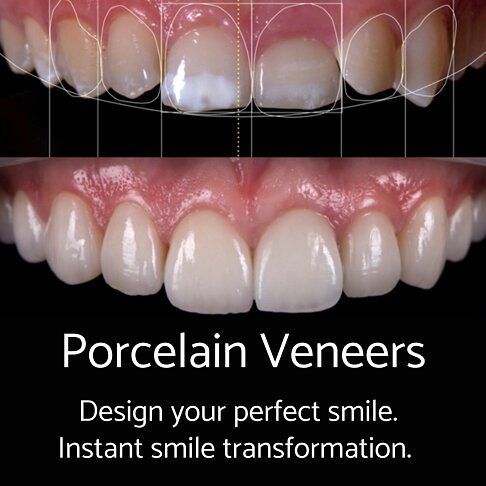 Diagram showing the effect of veneers on the appearance and shape of each top row tooth