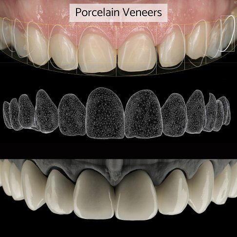 diagram showing a top row of irregular teeth alongside the veneers shell and the placement of veneer within the gumline