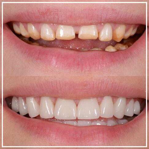 Porcelain Veneers London Worn Chipped Teeth