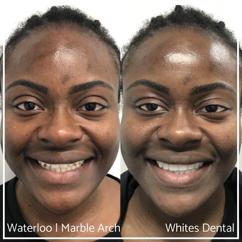 Full face view of composite bonding transformation, highlighting smile enhancement.