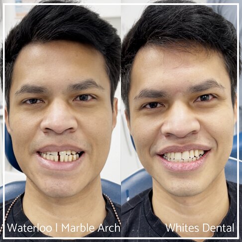 Full face photo comparison before and after composite bonding, showcasing improved smile.