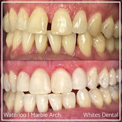 Composite Bonding Before And After Gaps In Teeth Cosmetic Dentist London 3