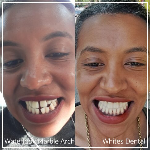 woman smiling to show teeth alignment issues before braces and a straight smile after a braces treatment