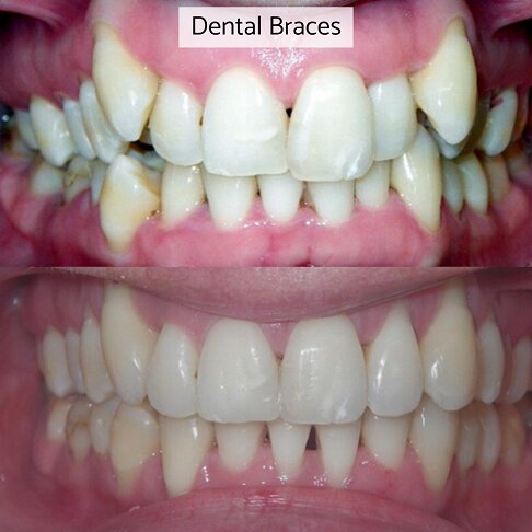 photo of the teeth and results of wearing a braces system