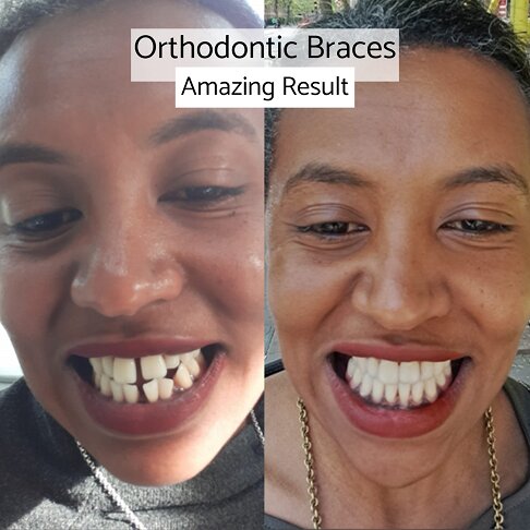 Fixed Braces London. Free Consultation