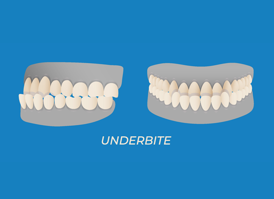 Underbite teeth