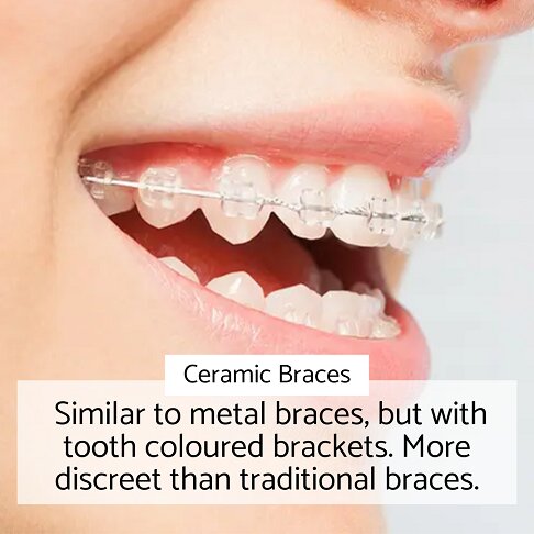 Adult Brace - Ceramic braces - similar to metal with tooth coloured brackets