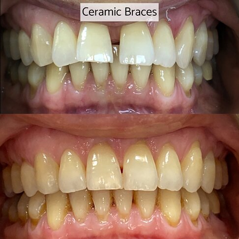 Adult Braces - Ceramic braces before and after