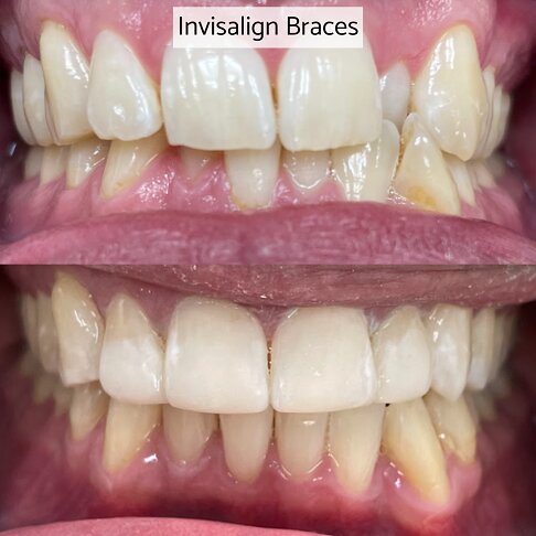 Adult Braces - Invisalign before and after