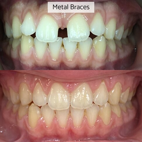 Adult Braces - Metal braces before and after