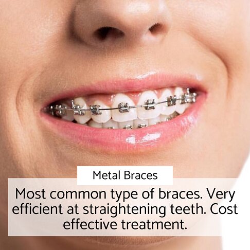 Adult Braces - Metal braces - cost effective treatment in London 2